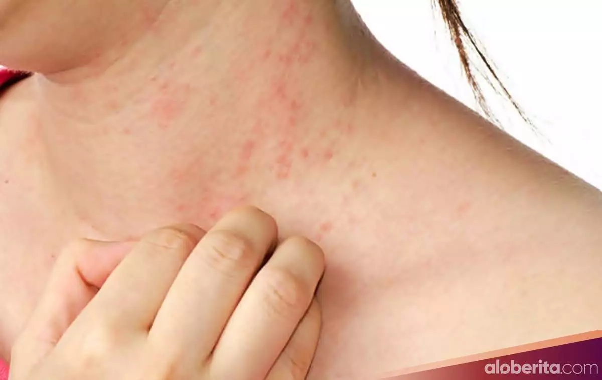 Cara mengatasi alergi kulit dengan bahan alami-2